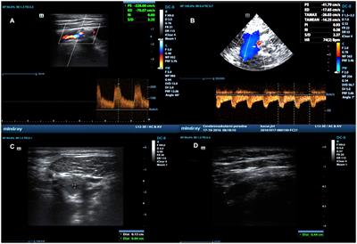 Peak systolic velocity ratio for evaluation of internal carotid artery stenosis correlated with plaque morphology: substudy results of the ANTIQUE study